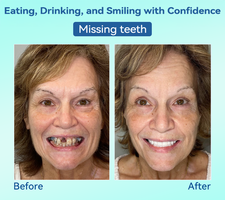 FlexiSmile Dentures - A Secure Smile, A Youthful Face + 50% OFF