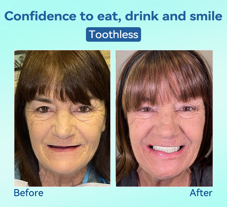 FlexiSmile Dentures - A Secure Smile, A Youthful Face + 50% OFF