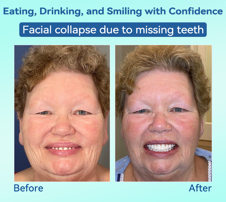 FlexiSmile Dentures - A Secure Smile, A Youthful Face + 50% OFF
