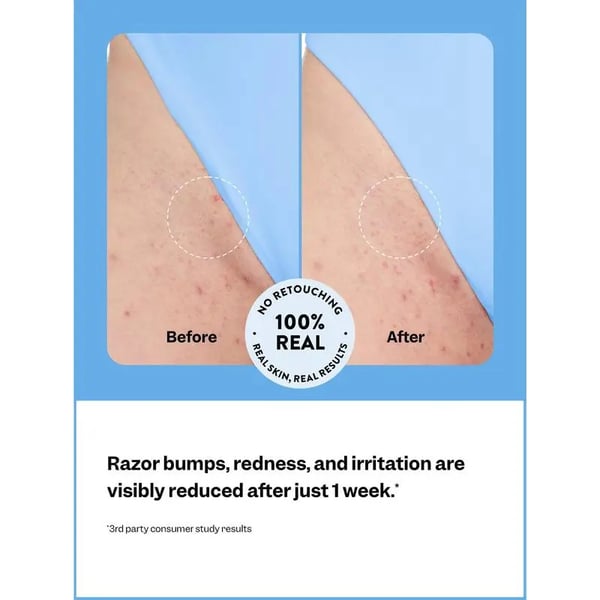 DermaCalm - The End of Ingrown Hairs & Razor Bumps - 50% OFF