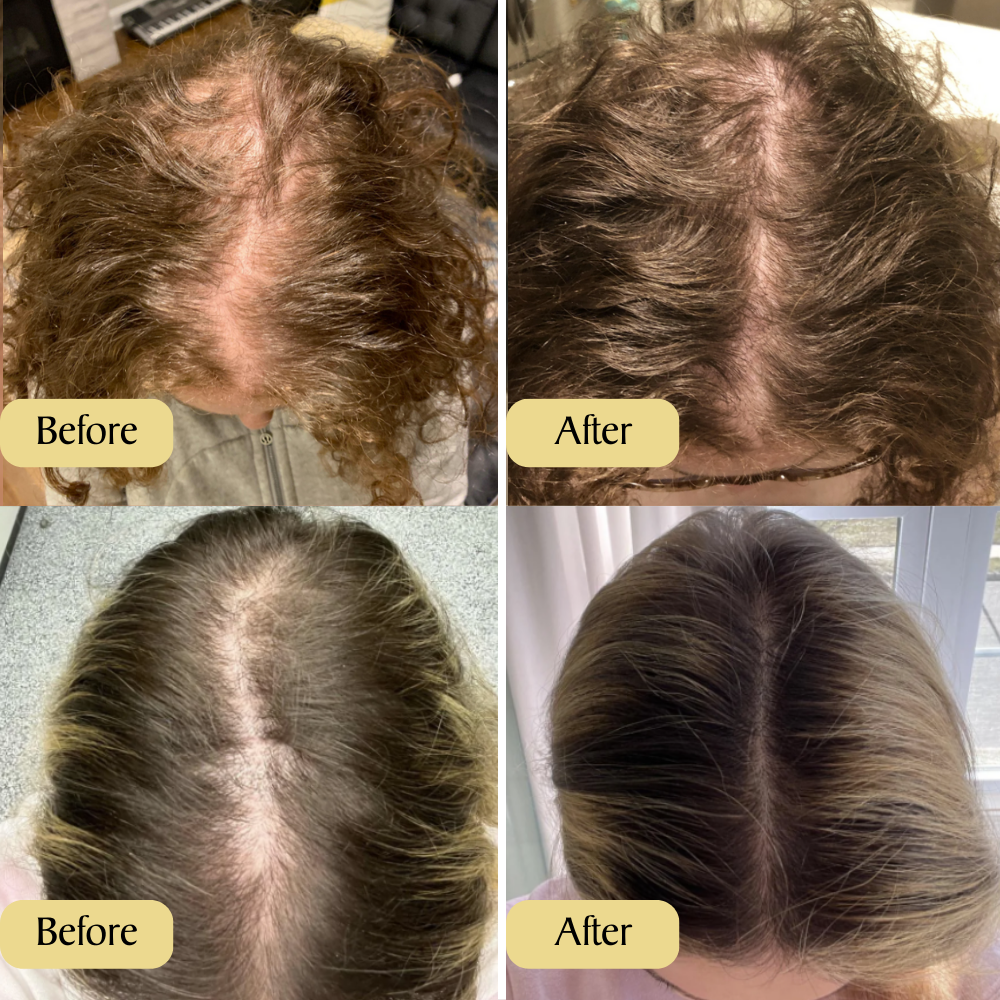 FolliGrow Elixir - Your Hair's Natural Revival - 50% OFF