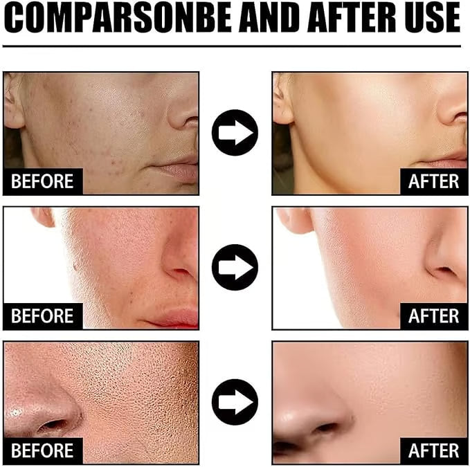 DermaClarity Elixir - Erase Post-Acne Marks - 50% OFF
