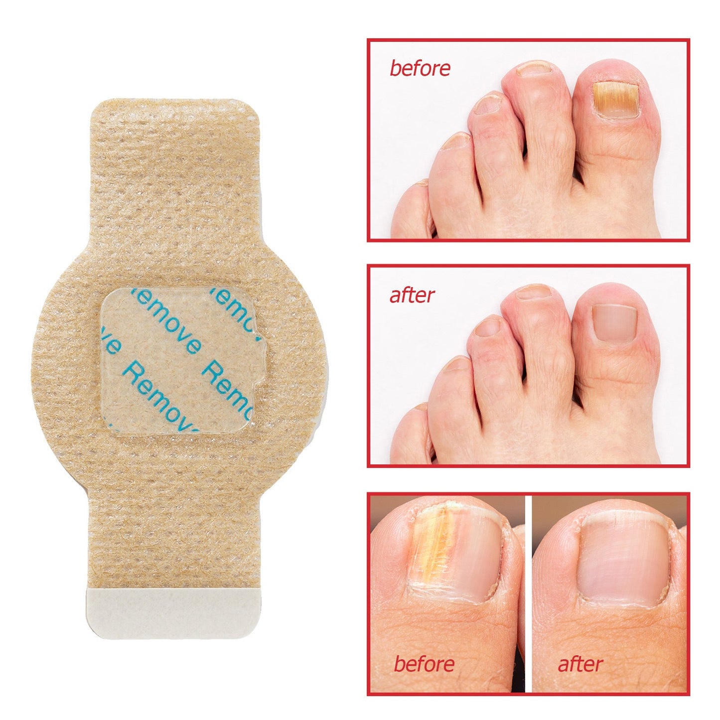 The NailRenew Overnight Patch - Healthier Nails While You Sleep + 50% OFF