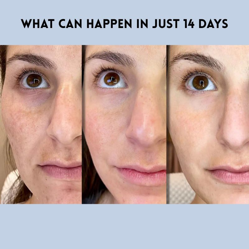 YouthLift Renew Strips – The Instant Solution for Timeless Beauty - Buy More Save More