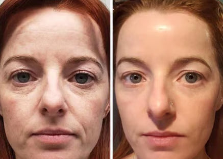 DermaClarity Elixir - Erase Post-Acne Marks - 50% OFF