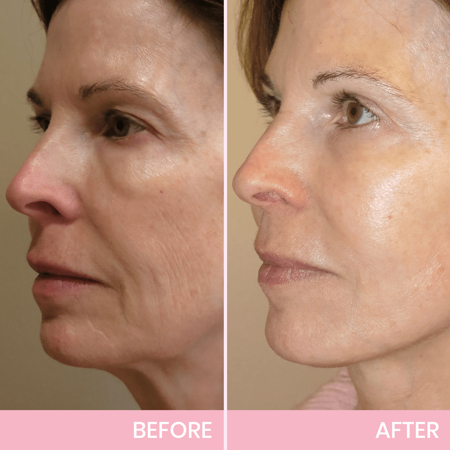 1 + 1 FREE - Instant V-Lift Tape – Lift Years Off Instantly!
