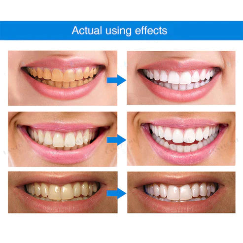 Ivory™ Teeth Whitening Essence (Limited Time Offer 50% Discount)