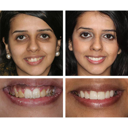 Ivory™ Teeth Whitening Essence (Limited Time Offer 50% Discount)