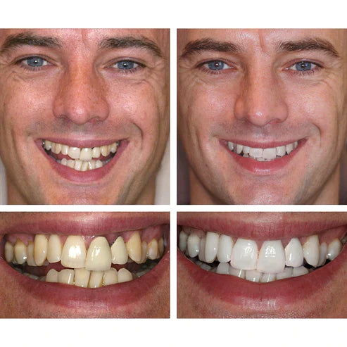 Ivory™ Teeth Whitening Essence (Limited Time Offer 50% Discount)