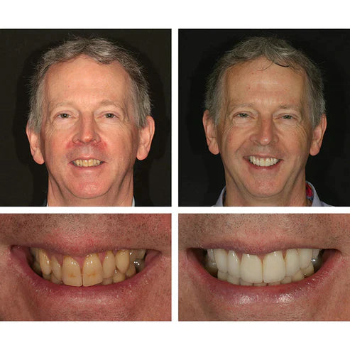 Ivory™ Teeth Whitening Essence (Limited Time Offer 50% Discount)