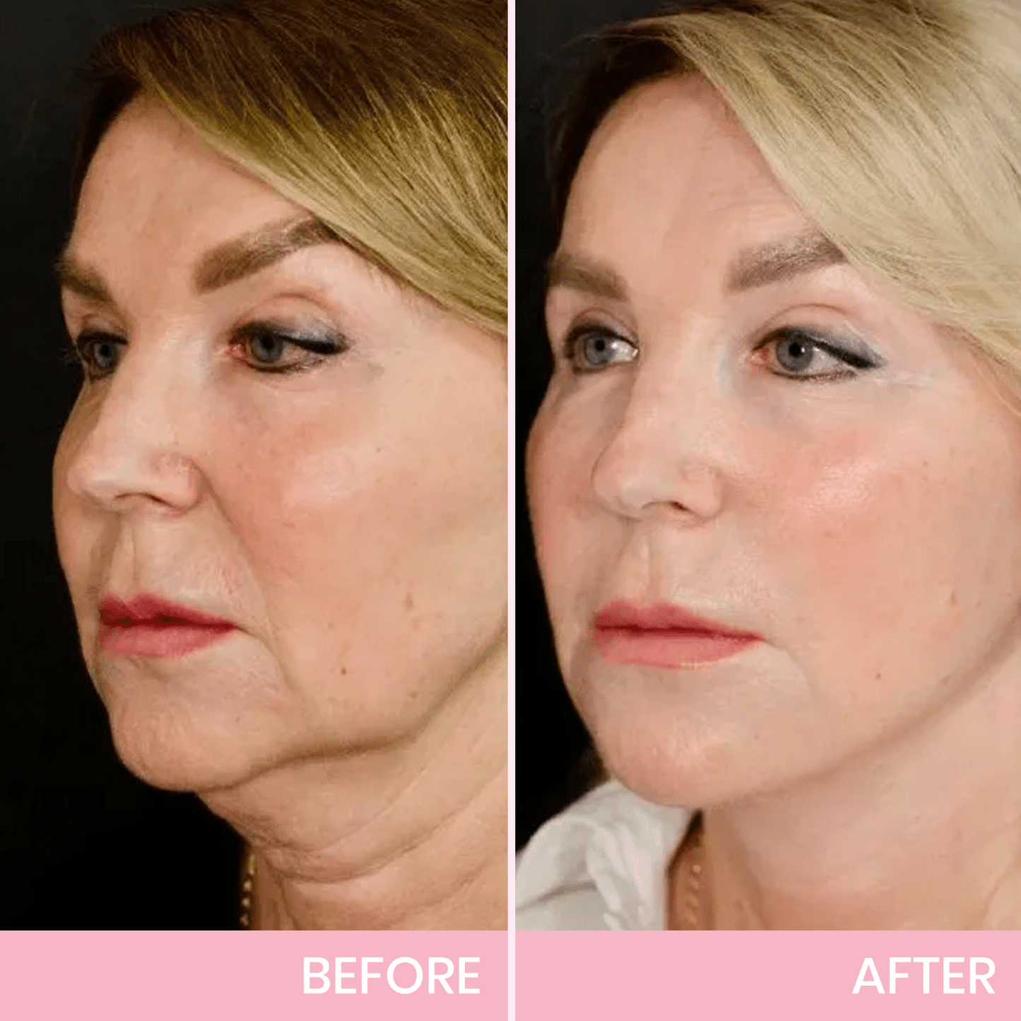 1 + 1 FREE - Instant V-Lift Tape – Lift Years Off Instantly!