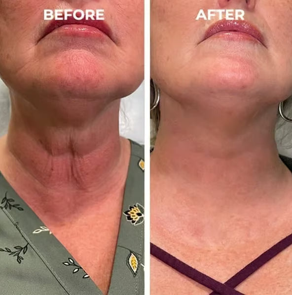 DermaClarity Elixir - Erase Post-Acne Marks - 50% OFF