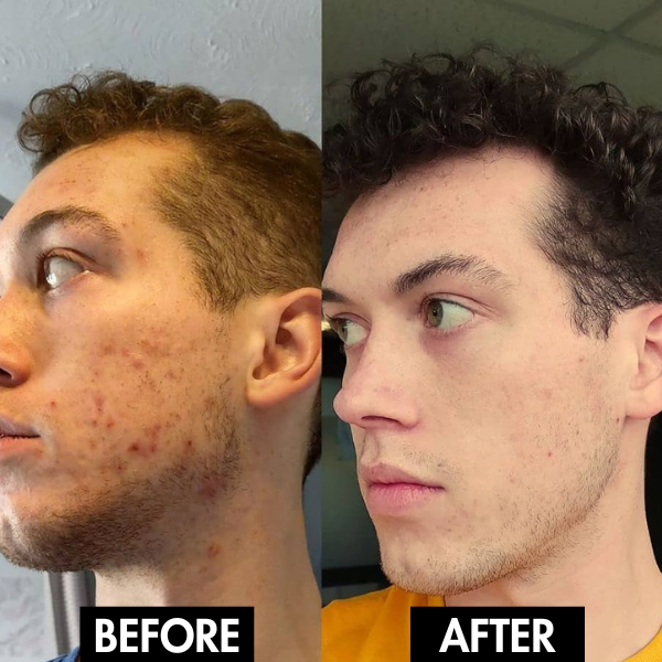 PureGlow: Your Solution for Radiant, Poreless Skin - 50% OFF