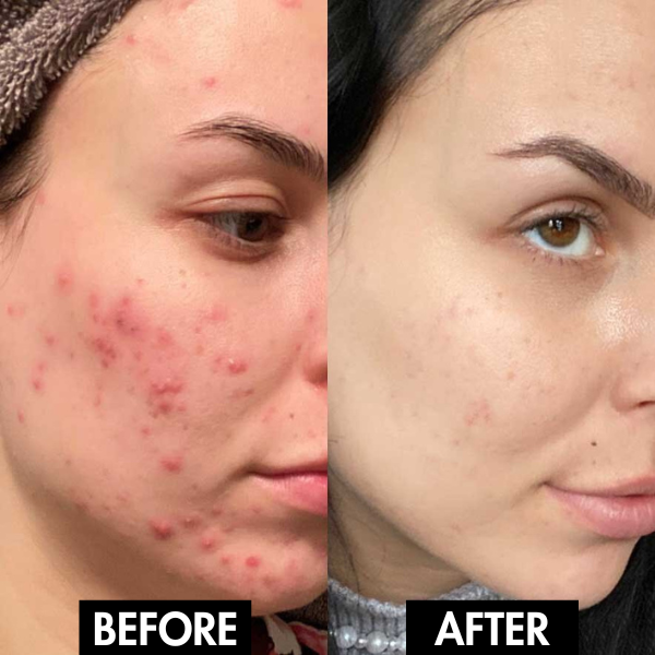 PureGlow: Your Solution for Radiant, Poreless Skin - 50% OFF