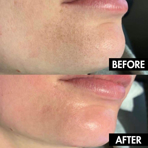 PureGlow: Your Solution for Radiant, Poreless Skin - 50% OFF