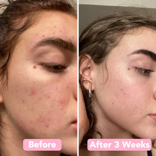The Turmeric & Kojic Acid Glow Pads - Fade Dark Spots, Effortlessly + 50% OFF