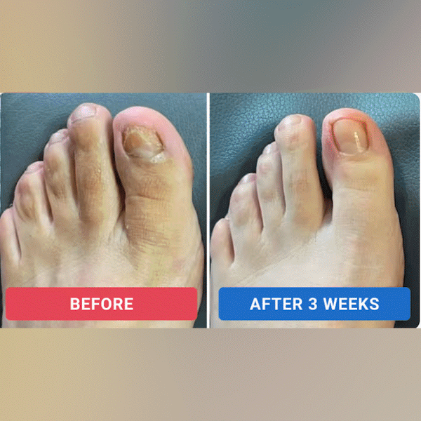 The NailRenew Overnight Patch - Healthier Nails While You Sleep + 50% OFF