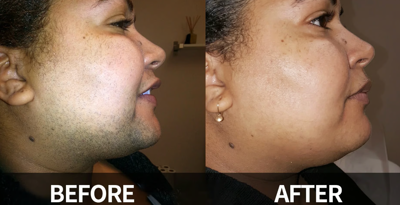 DermaSmooth Radiance- Reveal Your Flawlessly Smooth, Confident Glow 1 + 1 FREE