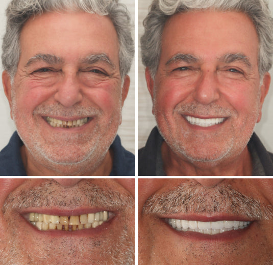Comfort-Fit Flexible Dentures – Natural Look Easy Wear & Removal - 60% OFF