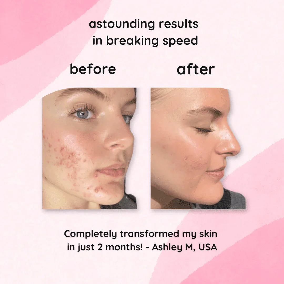 The Turmeric & Kojic Acid Glow Pads - Fade Dark Spots, Effortlessly + 50% OFF