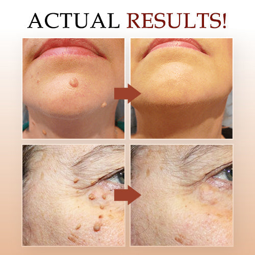 1 + 1 Free - WipeOff™ Marker & Mole Remover