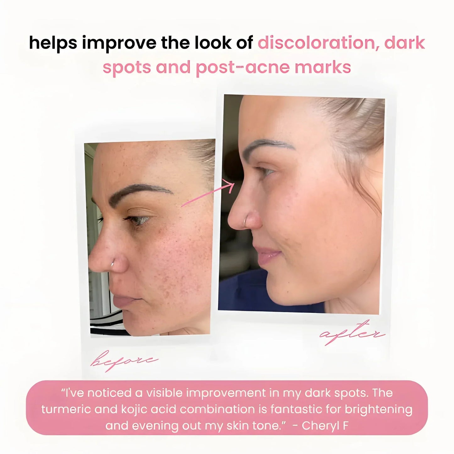 The Turmeric & Kojic Acid Glow Pads - Fade Dark Spots, Effortlessly + 50% OFF