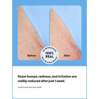 DermaCalm - The End of Ingrown Hairs & Razor Bumps - 50% OFF