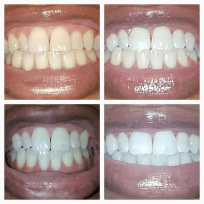 The SmileFitPro Pen - Whiter Smile in 7 Days, Zero Sensitivity +50% OFF