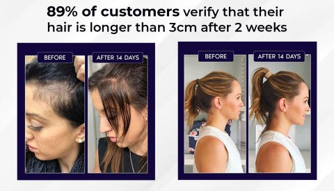 Lovilds Natural Hair Regrowth Spray - Clinically-Inspired Scalp Treatment - 1+1 FREE