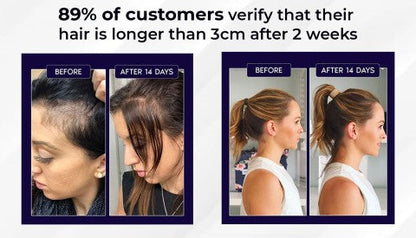 Lovilds Natural Hair Regrowth Spray - Clinically-Inspired Scalp Treatment - 1+1 FREE