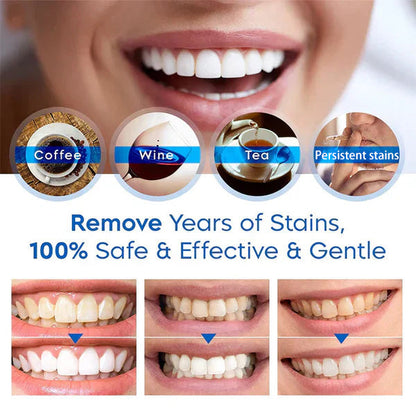 The SmileFitPro Pen - Whiter Smile in 7 Days, Zero Sensitivity +50% OFF