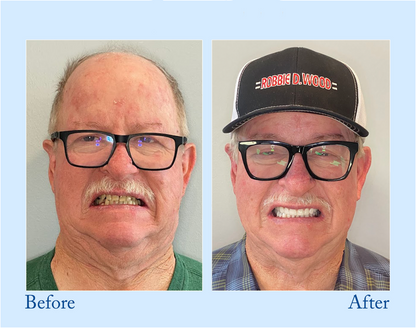 BBOJI™ Hydroxyapatite Toothpaste - Rebuild Enamel, End Sensitivity + 50% OFF