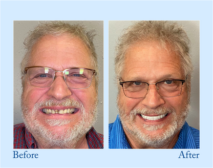 BBOJI™ Hydroxyapatite Toothpaste - Rebuild Enamel, End Sensitivity + 50% OFF
