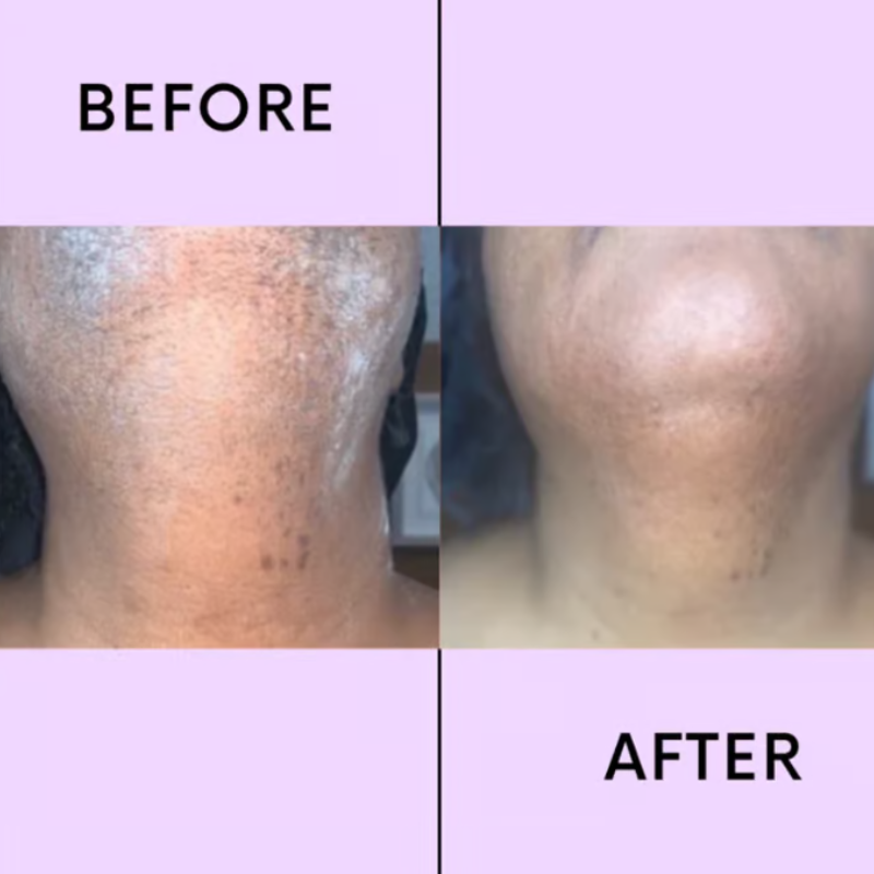 SmoothEase Facial Hair Remover - Smooth Skin, No Pain - 1+1 FREE