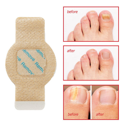 The NailRenew Overnight Patch - Healthier Nails While You Sleep + 50% OFF