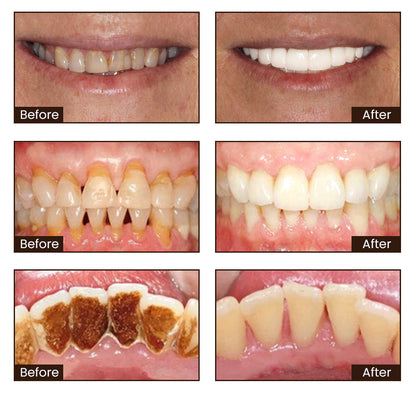 Pro-Denta Elixir - Restore Your Youthful Smile - BUY 1 GET 1 FREE