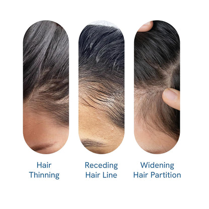 FolliRevive - Reawaken Your Hair Follicles - 50% OFF