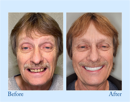 BBOJI™ Hydroxyapatite Toothpaste - Rebuild Enamel, End Sensitivity + 50% OFF