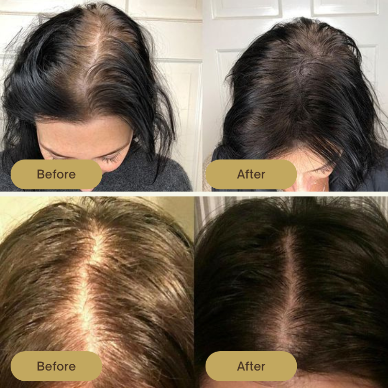 FolliPrime Synergy Oil - Achieve Visibly Thicker, Fuller Hair and Renewed Confidence - 1 + 1 FREE