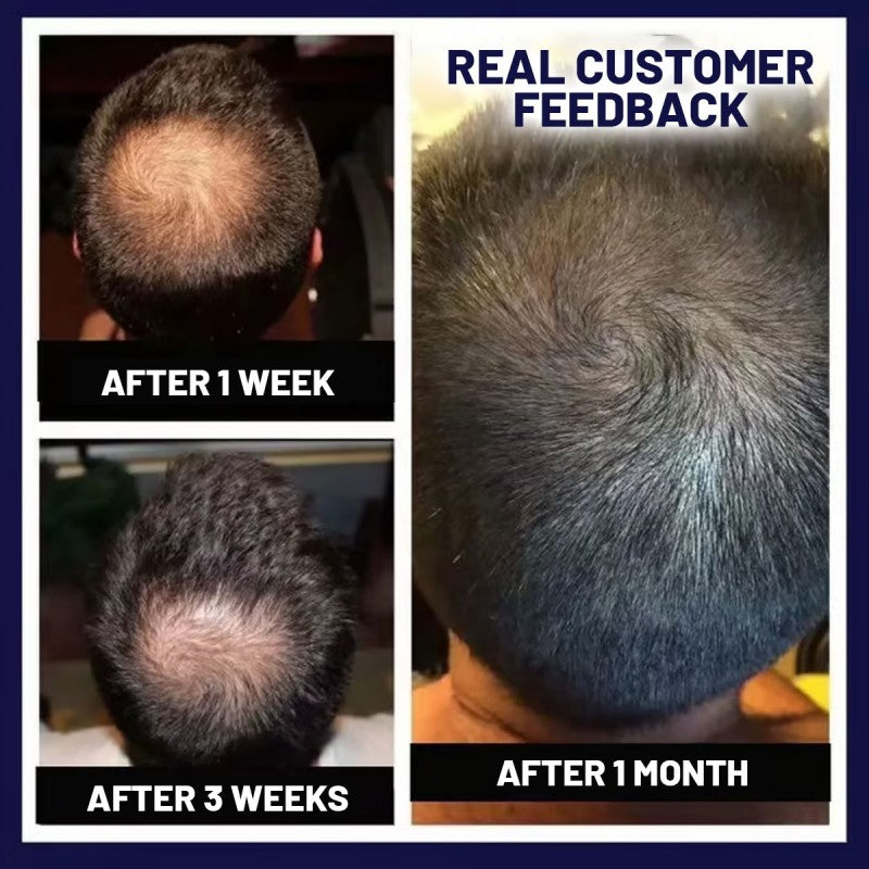 Lovilds Natural Hair Regrowth Spray - Clinically-Inspired Scalp Treatment - 1+1 FREE