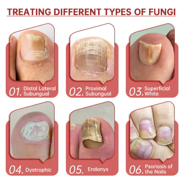 FungaClear Triple-Action Nail Repair - Clear Nails, Renewed Confidence + 1+1 FREE