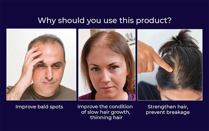 Lovilds Natural Hair Regrowth Spray - Clinically-Inspired Scalp Treatment - 1+1 FREE