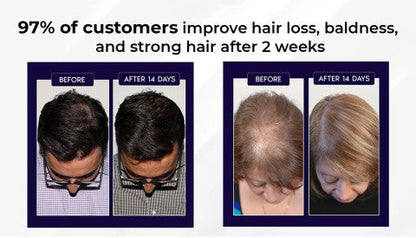 Lovilds Natural Hair Regrowth Spray - Clinically-Inspired Scalp Treatment - 1+1 FREE