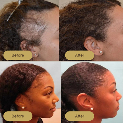FolliPrime Synergy Oil - Achieve Visibly Thicker, Fuller Hair and Renewed Confidence - 1 + 1 FREE