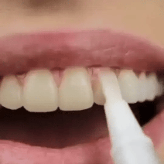 The SmileFitPro Pen - Whiter Smile in 7 Days, Zero Sensitivity +50% OFF