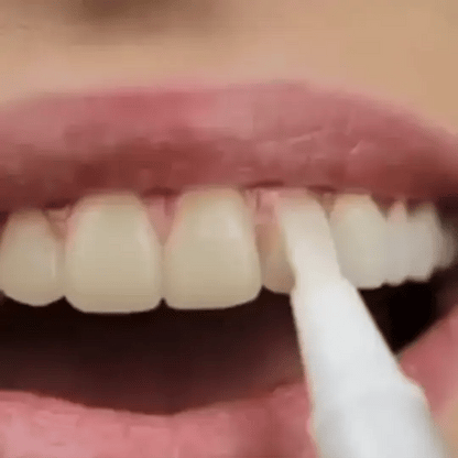 The SmileFitPro Pen - Whiter Smile in 7 Days, Zero Sensitivity +50% OFF