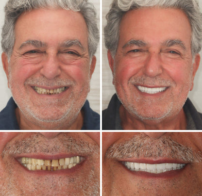 Comfort-Fit Flexible Dentures – Natural Look Easy Wear & Removal - 60% OFF