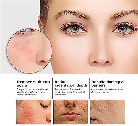 DermaClarity Elixir - Erase Post-Acne Marks - 50% OFF