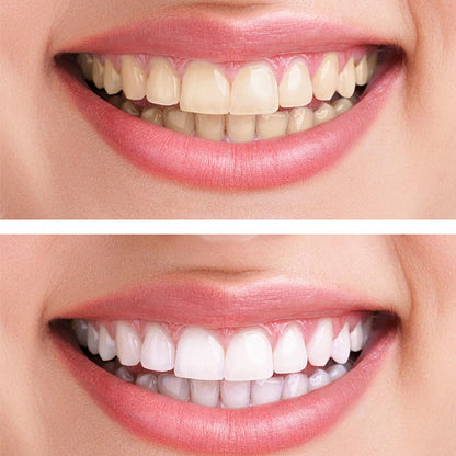 Revitrin - Rebuild Your Enamel, Restore Your Smile - 50% OFF